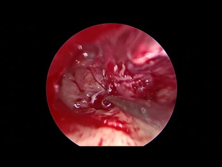 Endoskopowa tympanoplastyka rewizyjna w przewodzeniowym ubytku słuchu