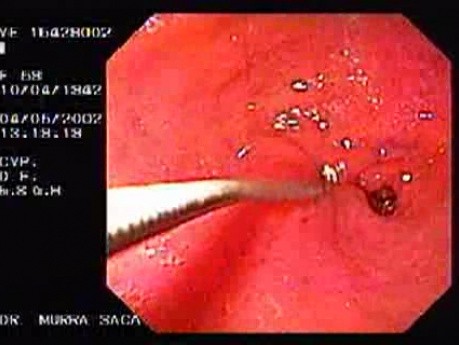 Gruczolakorak jamy żołądka - endoskopia (2 z 2)