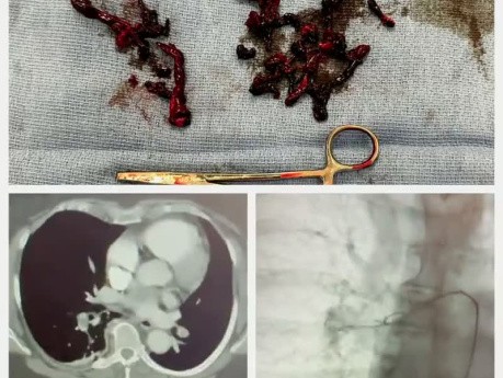 Embolektomia u pacjenta z masywnym zatorem płucnym 