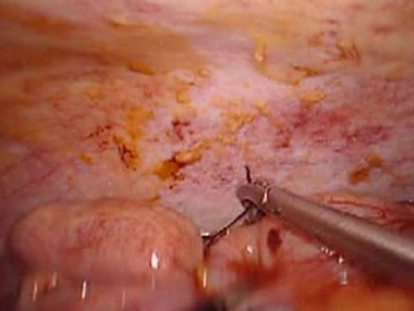 Perforacja okrężnicy z zapaleniem otrzewnej - laparoskopia (22 z 46)
