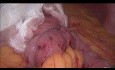  Laparoskopowa operacja pętlowego wyłączenia żołądkowo-jelitowego
