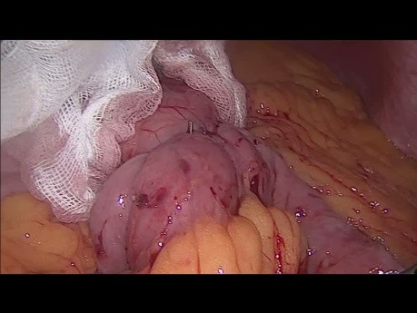 Laparoskopowa operacja pętlowego wyłączenia żołądkowo-jelitowego