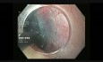 Endoskopowa resekcja guza podśluzówkowego (STER) przełyku - mięśniak gładkookomórkowy
