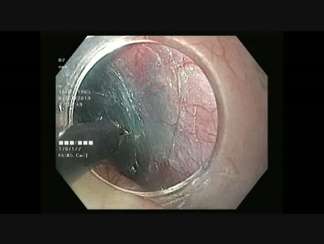 Endoskopowa resekcja guza podśluzówkowego (STER) przełyku - mięśniak gładkookomórkowy