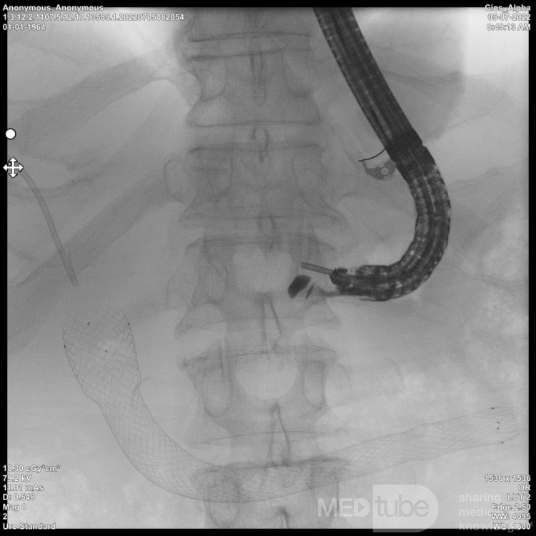 Endoskopowa hepaticogastrostomia pod kontrolą EUS [1/10]