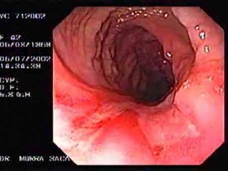 Choroba Leśniowskiego - Crohna - endoskopia (24 z 28)