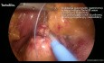 Hemostaza i uszczelnienie tkanek w laparoskopowej chirurgii górnego piętra przewodu pokarmowego