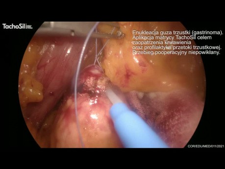 Hemostaza i uszczelnienie tkanek w laparoskopowej chirurgii górnego piętra przewodu pokarmowego