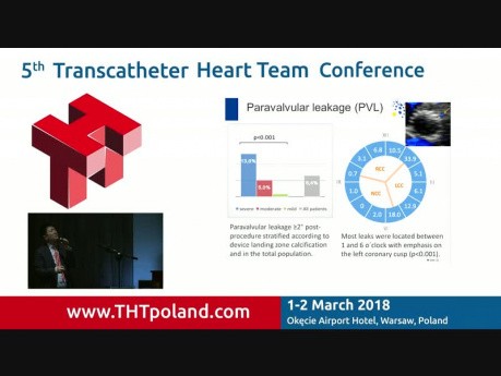Acurate Neo and AS neo Transcatheter Heart Valves