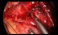 Minimalnie inwazyjna pętla i uwolnienie tętnicy płucnej metodą laparoskopową