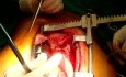 Rewaskularyzacja mięśnia sercowego metodą off-pump (na bijącym sercu)