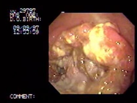 Gruczolakorak żołądka - obstrukcja - gastroskopia