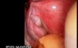 Laparoskopia diagnostyczna
