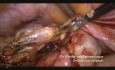 Ciąża ektopowa- laparoskopia ratunkowa