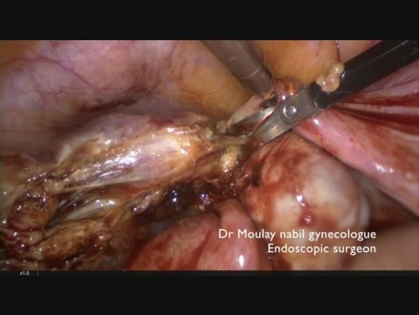 Ciąża ektopowa- laparoskopia ratunkowa