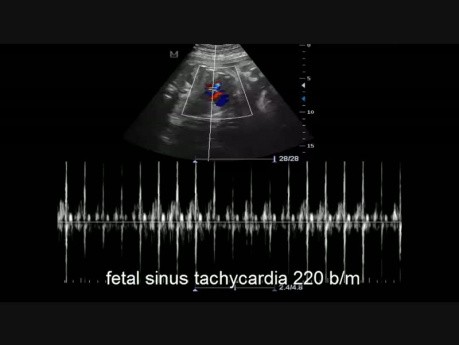 Tachykardia zatokowa u płodu