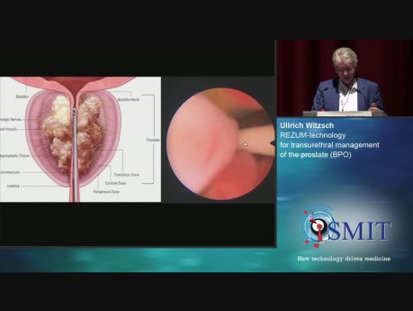 REZUM - nowa minimalnie inwazyjna metoda leczenia łagodnego rozrostu prostaty - SMIT 2019 