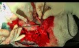 Ostry krwiak podtwardówkowy