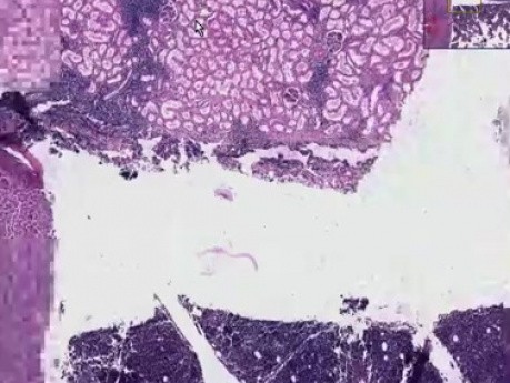 Przewlekła białaczka limfocytarna - histopatologia - węzeł chłonny, szpik, nerka, wątroba