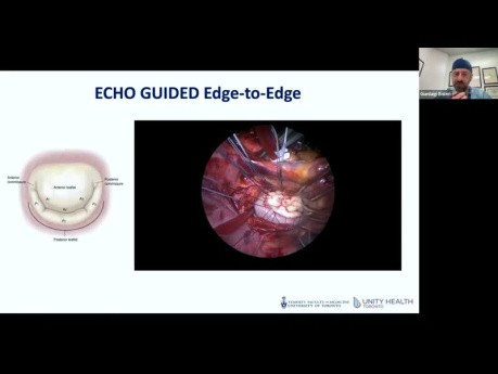 Echo i minimalnie inwazyjna kardiochirurgia (MCIS) zastawki mitralnej 
