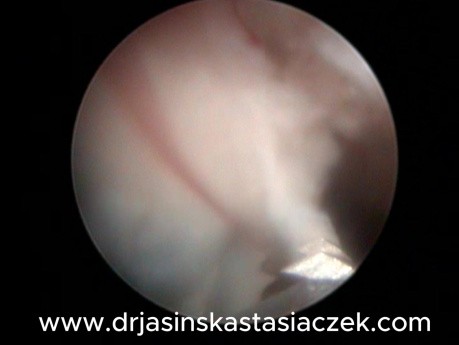 Mikrohisteroskopia z użyciem 15FR shaver (średnica 5mm) - duży krwawiący guz