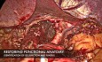 Laparoskopowa reoperacja fundoplikacji