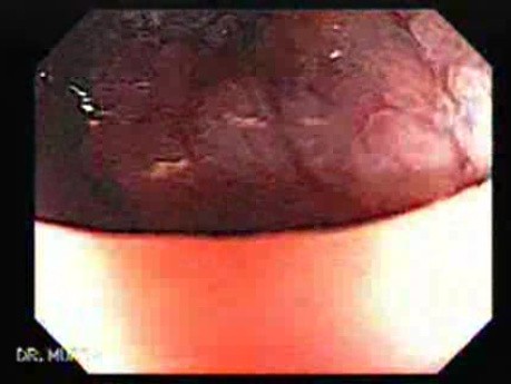 Gruczolakorak odbytnicy - kolonoskopia (7 z 8)