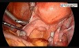 Laparoskopowa hysterektomia z instalacją stentu moczowodowego