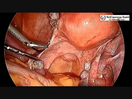 Laparoskopowa hysterektomia z instalacją stentu moczowodowego