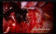 Metody preparowania tętnicy płucnej zablokowanej przez zwapniałe węzły chłonne