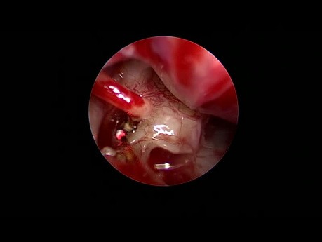 Endoskopowa stapedotomia w otosklerozie (laser diodowy)