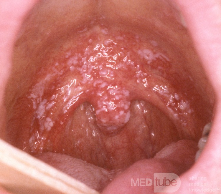 Kandydoza jamy ustnej (pleśniawka)