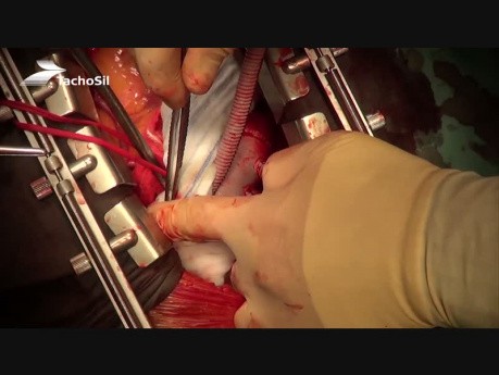 Zastosowanie hemostatyczno-uszczelniające TachoSil w kardiochirurgii