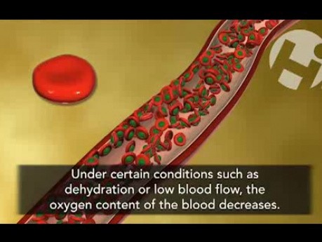 Anemia sierpowata (niedokrwistość sierpowata)