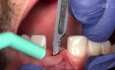 Natychmiastowa implantacja po awulsji