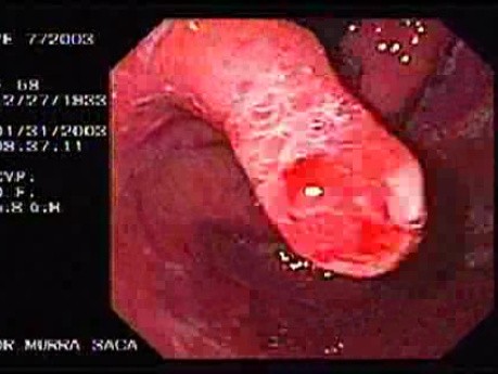 Hiperplastyczny polip - wpust żołądka