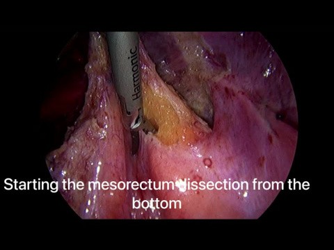 Endometriosis excision 