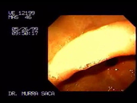 Endoskopowy obraz prawidłowego żołądka