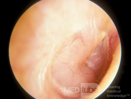 Nerwiak nerwu słuchowego w uchu środkowym