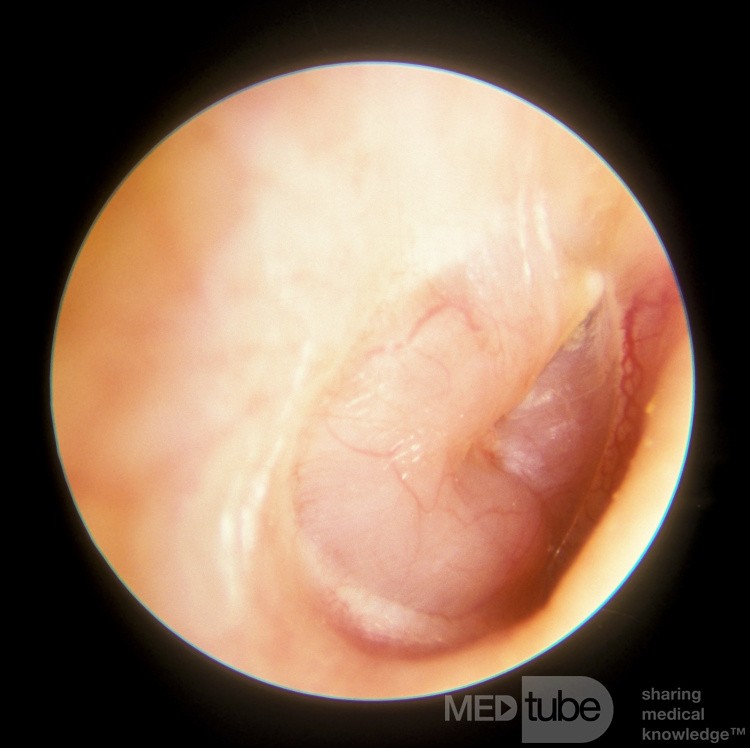 Nerwiak nerwu słuchowego w uchu środkowym