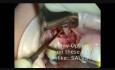 Podnoszenie dna zatoki pod implanty stomatologiczne