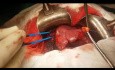 Resekcja anatomiczna segmentów IVb i V wątroby (bisegmentektomia)