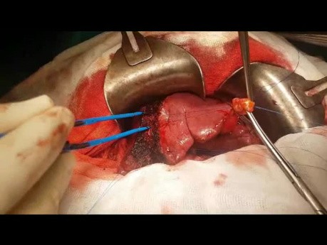 Resekcja anatomiczna segmentów IVb i V wątroby (bisegmentektomia)