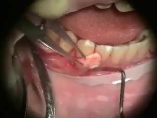 Przeszczepy periodontologiczne - mikrochirurgia