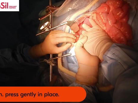 TachoSil zapewnia odpowiednią hemostazę i uszczelnienie podczas przeszczepu fragmentu wątroby u 4-letniego pacjenta
