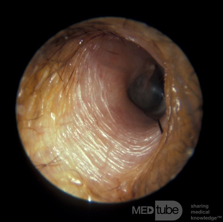 Poprzeczne zmarszczki na nabłonku w głębi przewodu słuchowego