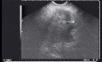 Rak trzustki - endoultrasonografia (EUS) z biopsją cienkoigłową