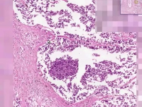 Rak drobnokomórkowy - histopatologia - płuco