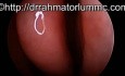 Perforacja przegrody nosa [otwór w przegrodzie jamy nosowej] w HD
