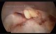 Zabieg discektomii lędźwiowej metodą endoskopową